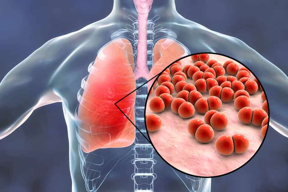 Nguyên nhân gây viêm phổi có thể do vi khuẩn, virus hoặc do nấm.