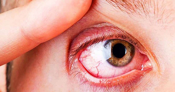 Chuyên gia cảnh báo các căn bệnh về mắt dễ mắc phải trong mùa hè và cách phòng tránh