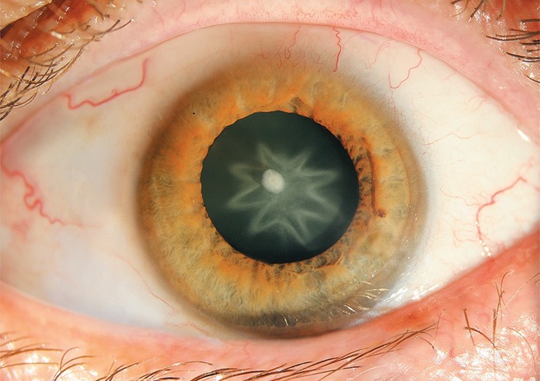 cataracte-en-etoile-stellar-cataract