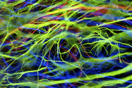 Tế bào gốc “tái lập trình” được cấy ghép vào bệnh nhân Parkinson