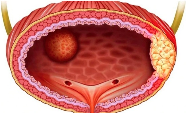 Thanh niên 26 tuổi bị ung thư bàng quang thừa nhận có 1 thói quen nhiều nam giới Việt mắc phải- Ảnh 3.