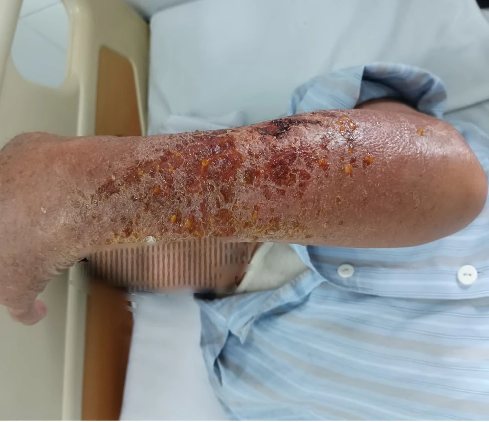患者の感染した腕。（写真：BVCC）