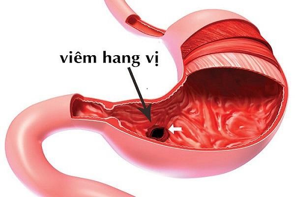 Viêm hang vị dạ dày có nguy hiểm không? - Ảnh 1.