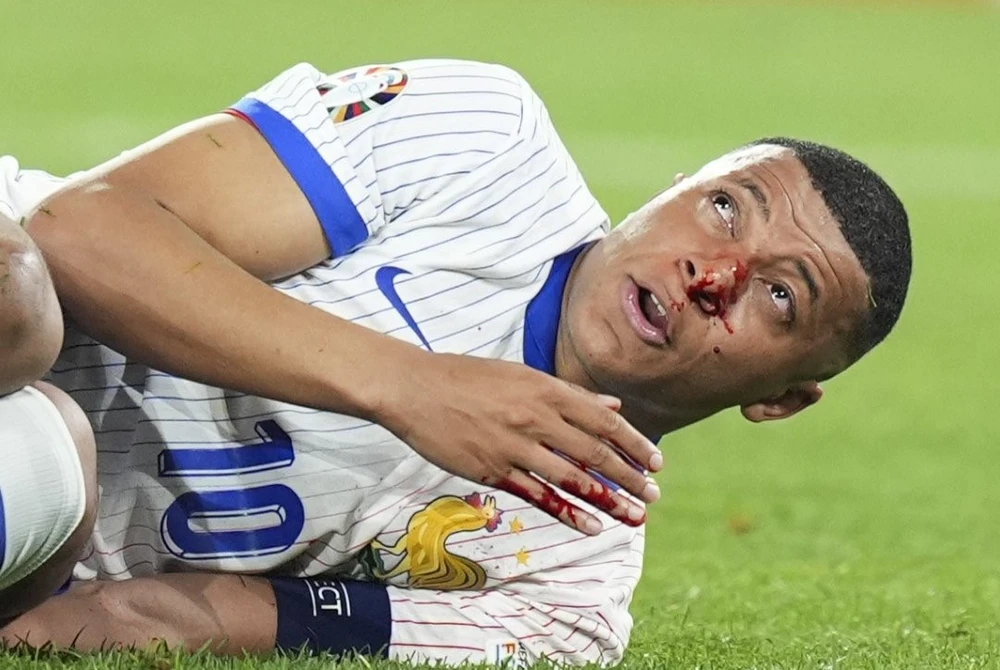 Mbappe suffered a nose injury in France's 1-0 win over Austria. (Source: X)