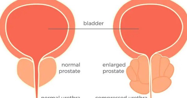 Lasermethoden zur Behandlung einer Prostatavergrößerung