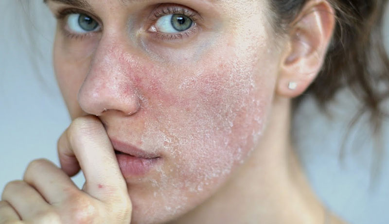 Cách khắc phục 4 kiểu tổn thương da thường gặp sau Tết